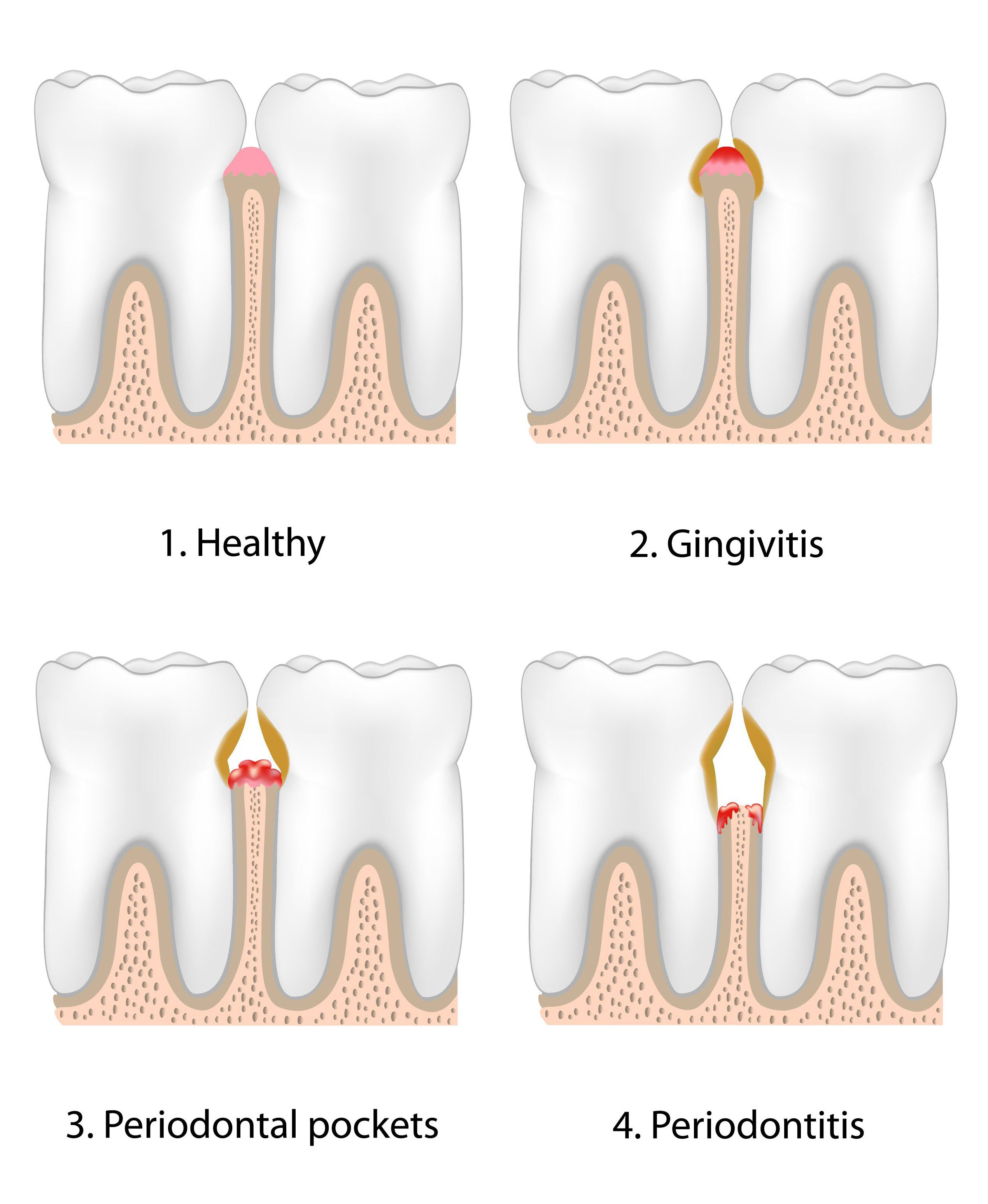 Gum Disease Treatment in Secunderabad