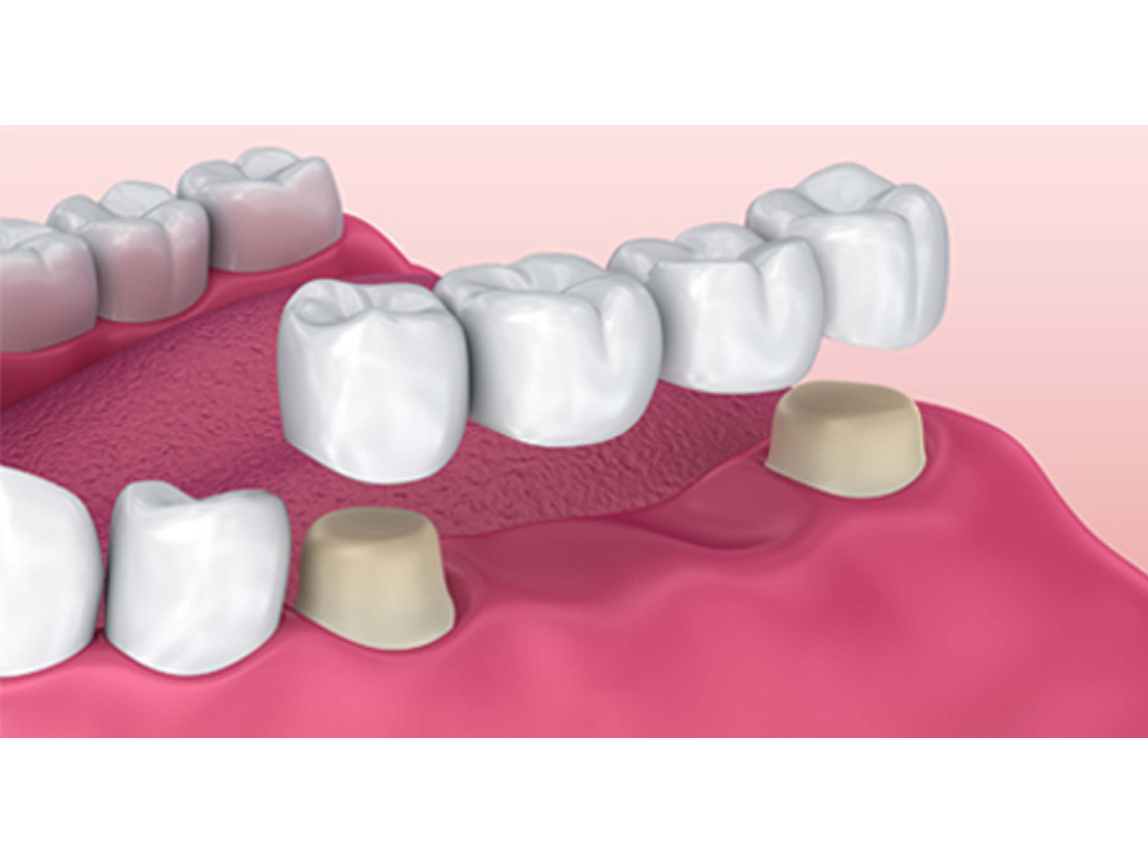 Dental Crowns and Bridges in Secunderabad