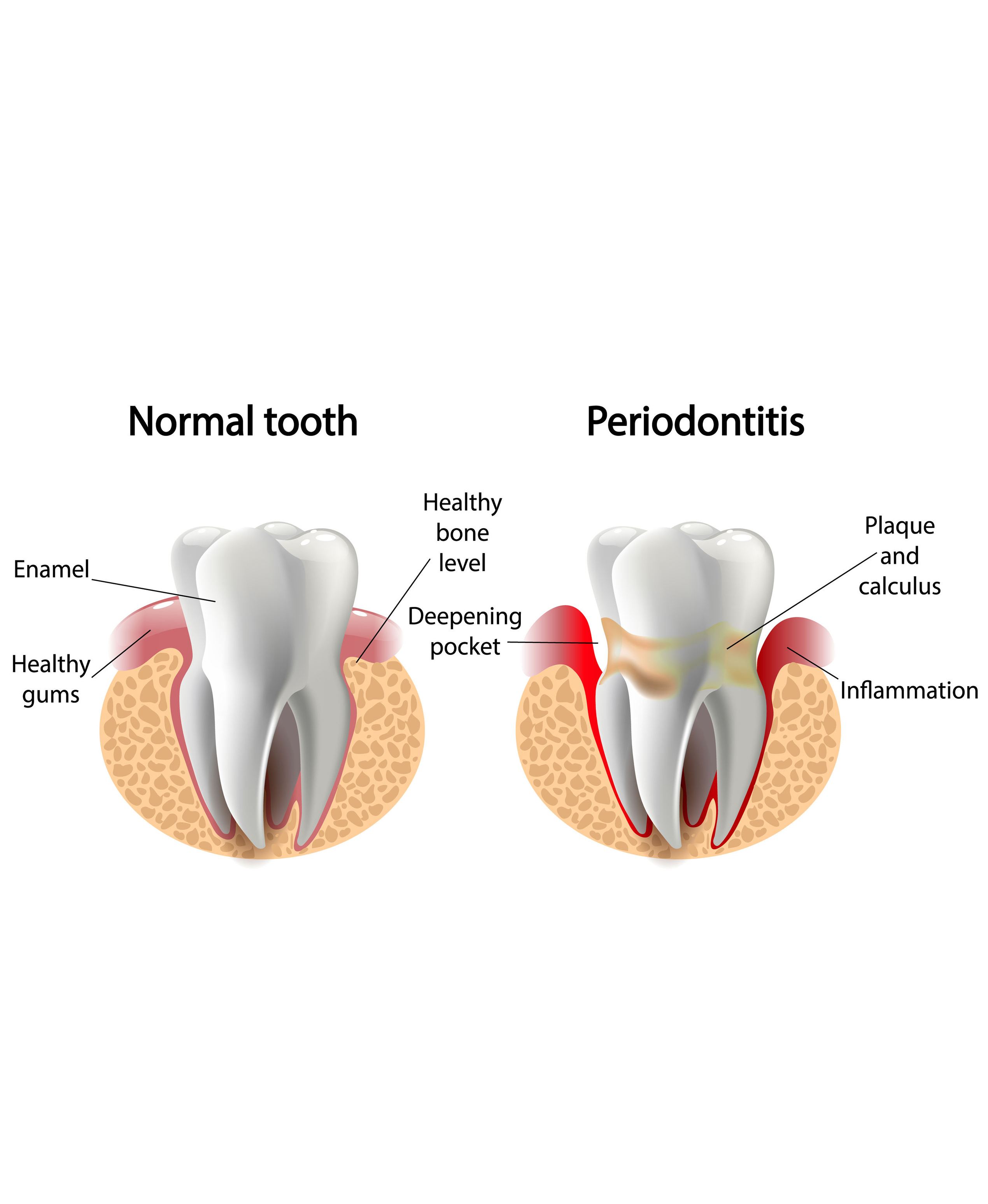Gum Disease Treatment in Secunderabad