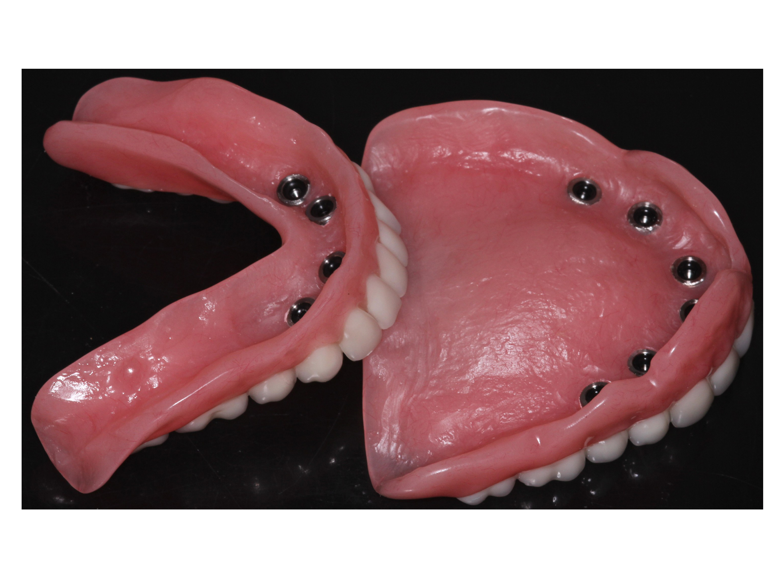 Best Dental Implant Clinic in Secunderabad