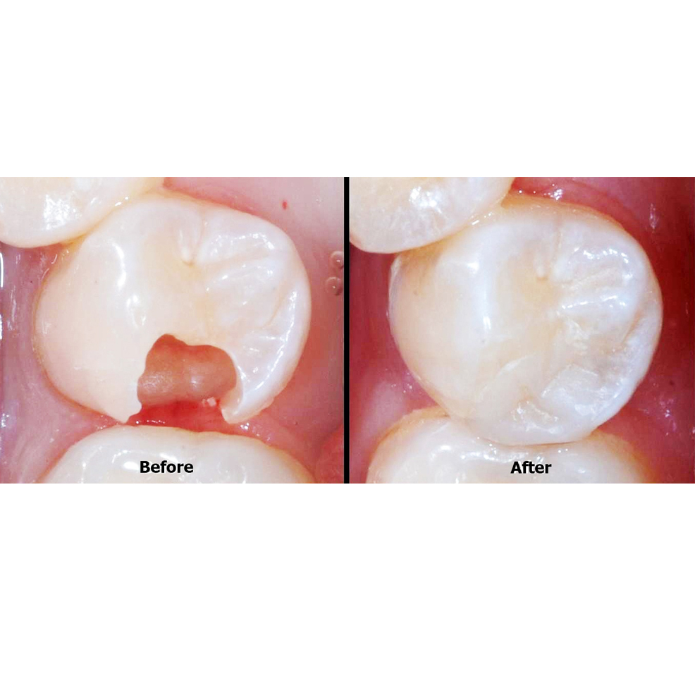 Cosmetic Dental Fillings in West Marredpally