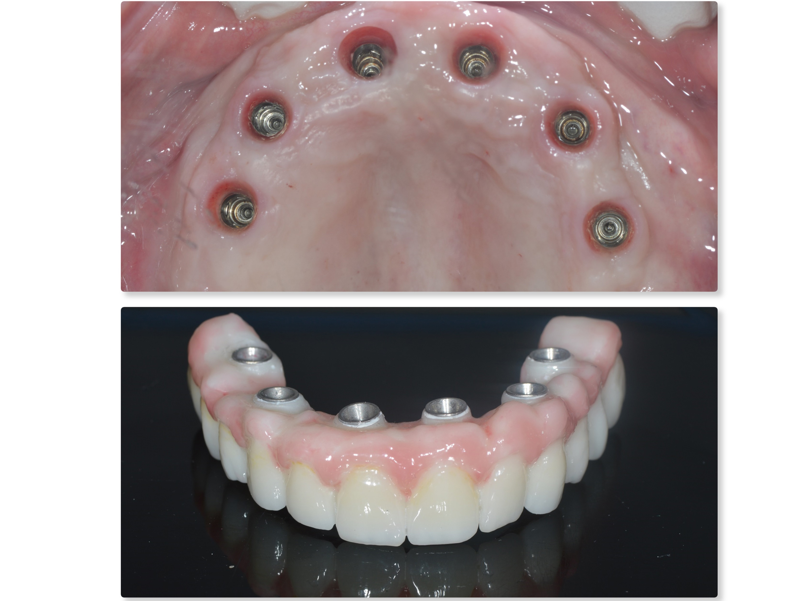 Best Dental Implant Clinic in Secunderabad