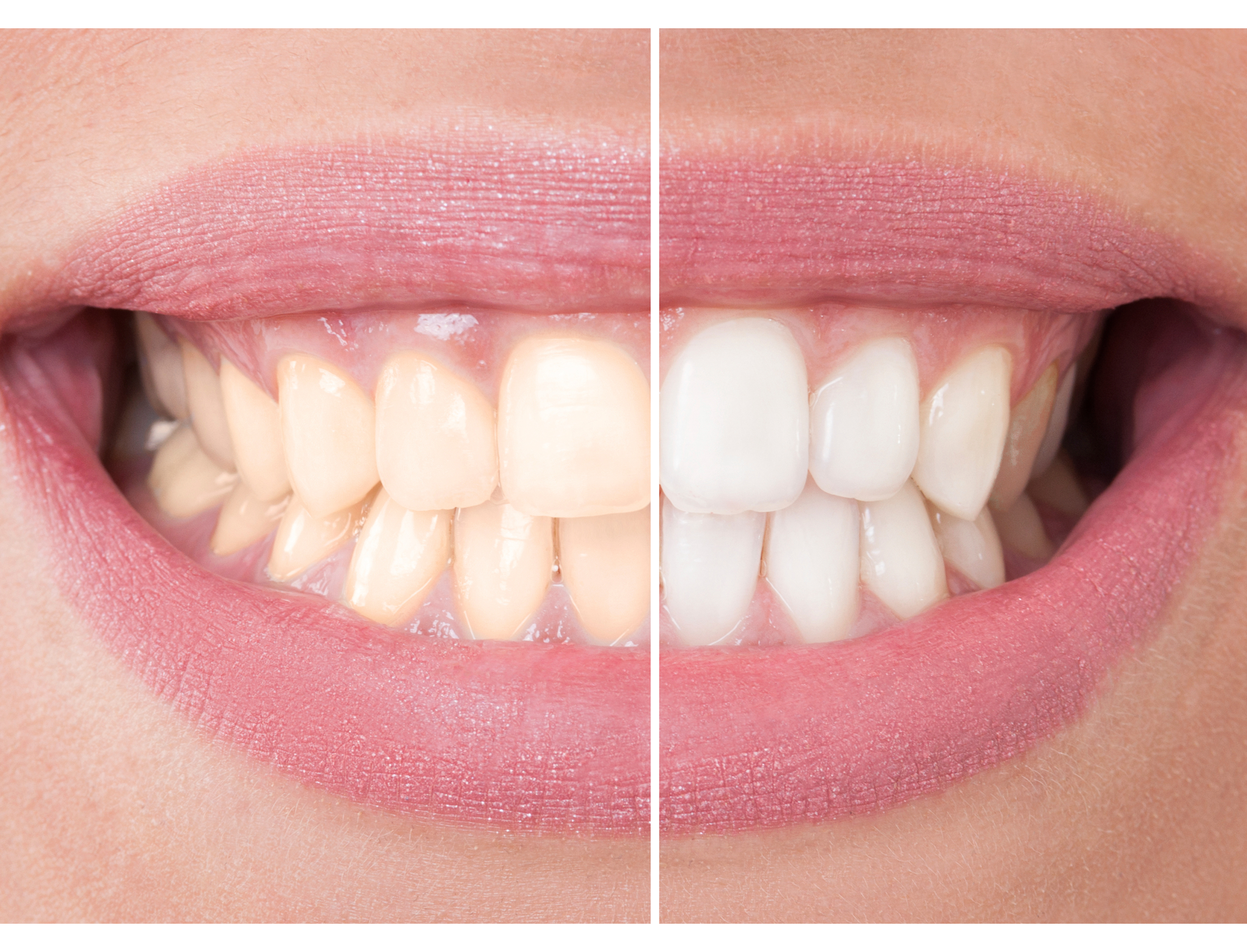 Teeth Whitening in Secunderabad