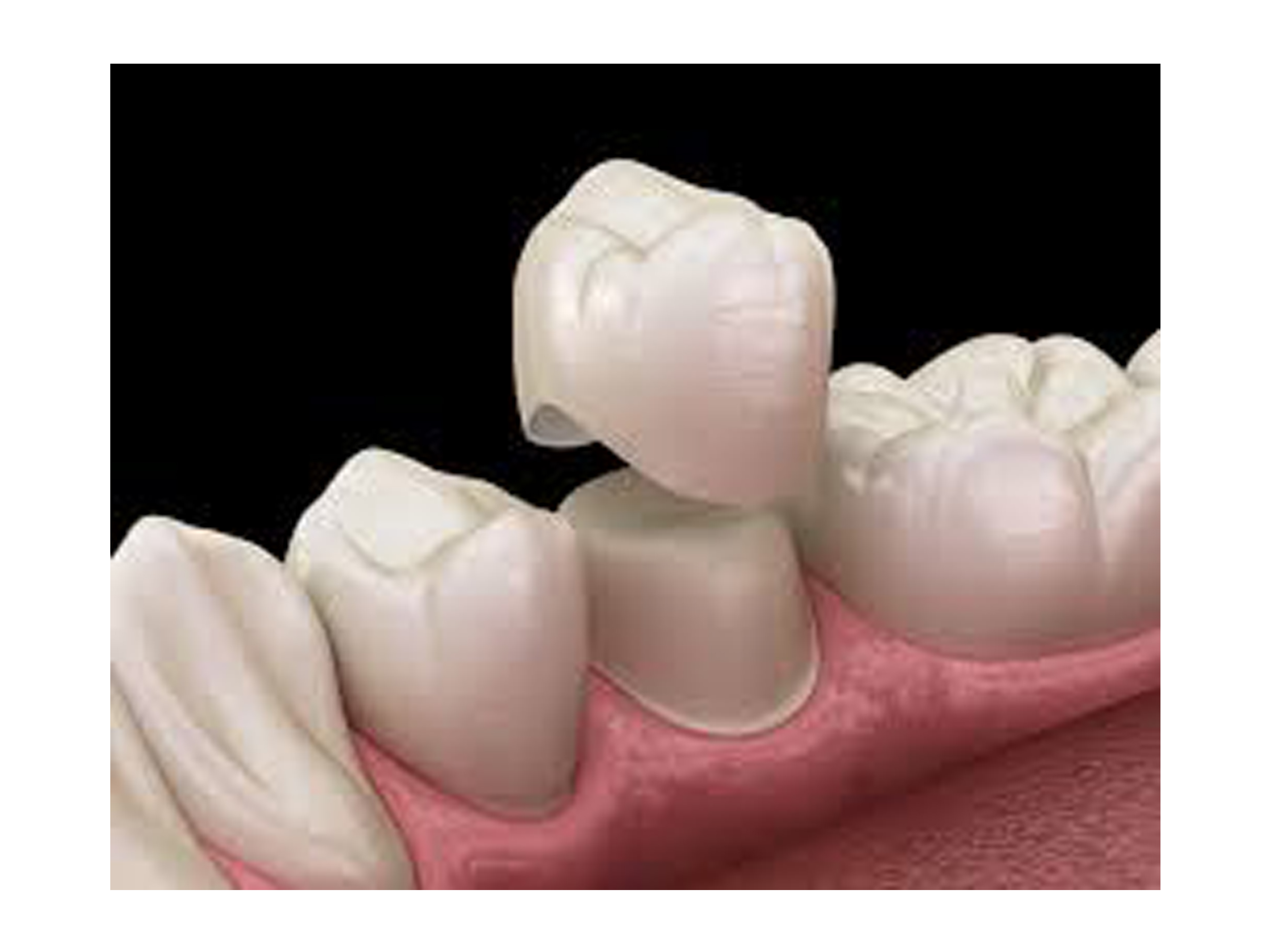 Dental Crowns and Bridges in Secunderabad