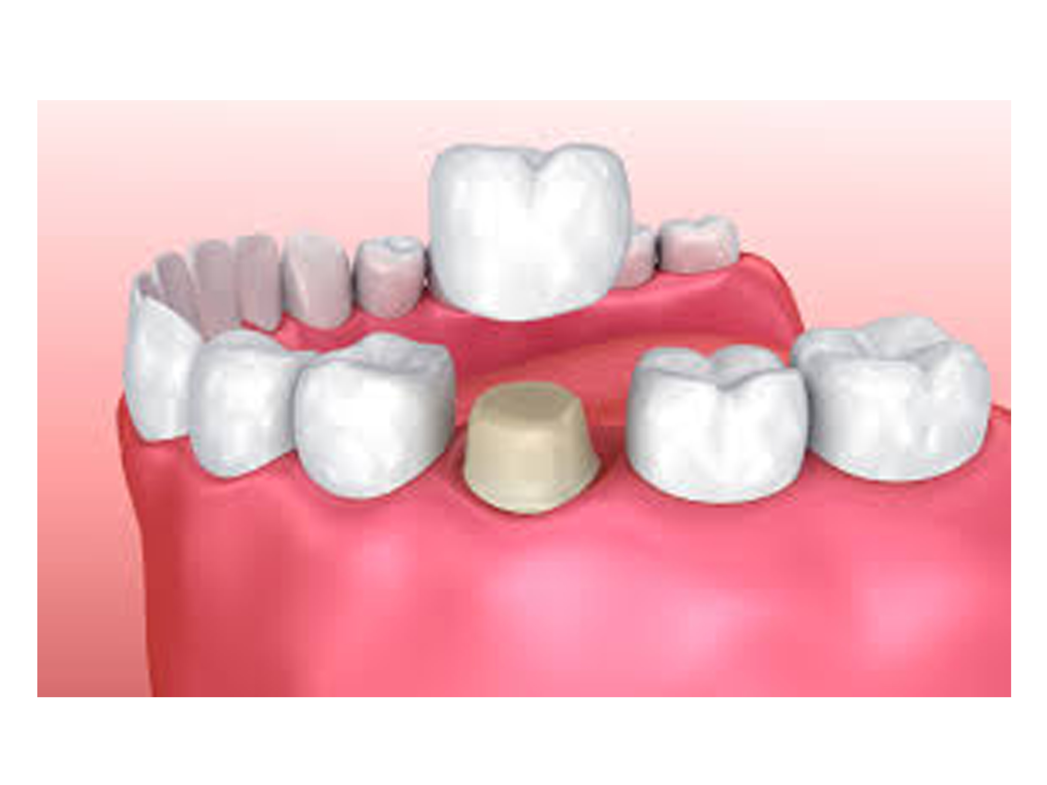 Dental Crowns and Bridges in Secunderabad