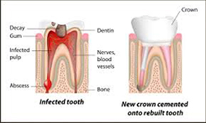 Root Canal Treatment in Secunderabad