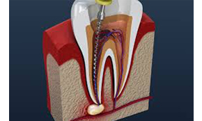 Root Canal Treatment in Secunderabad