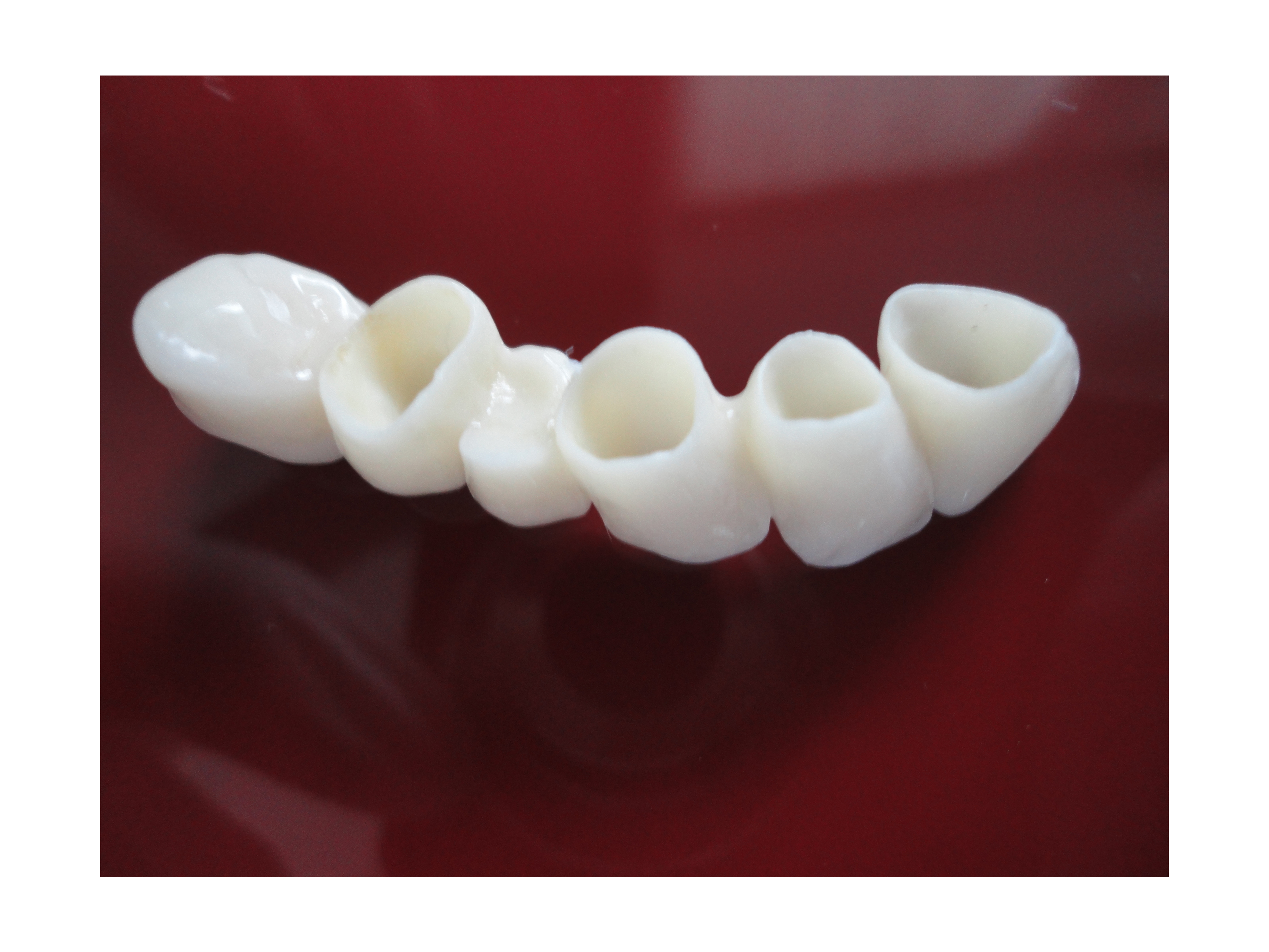 Dental Crowns and Bridges in Secunderabad