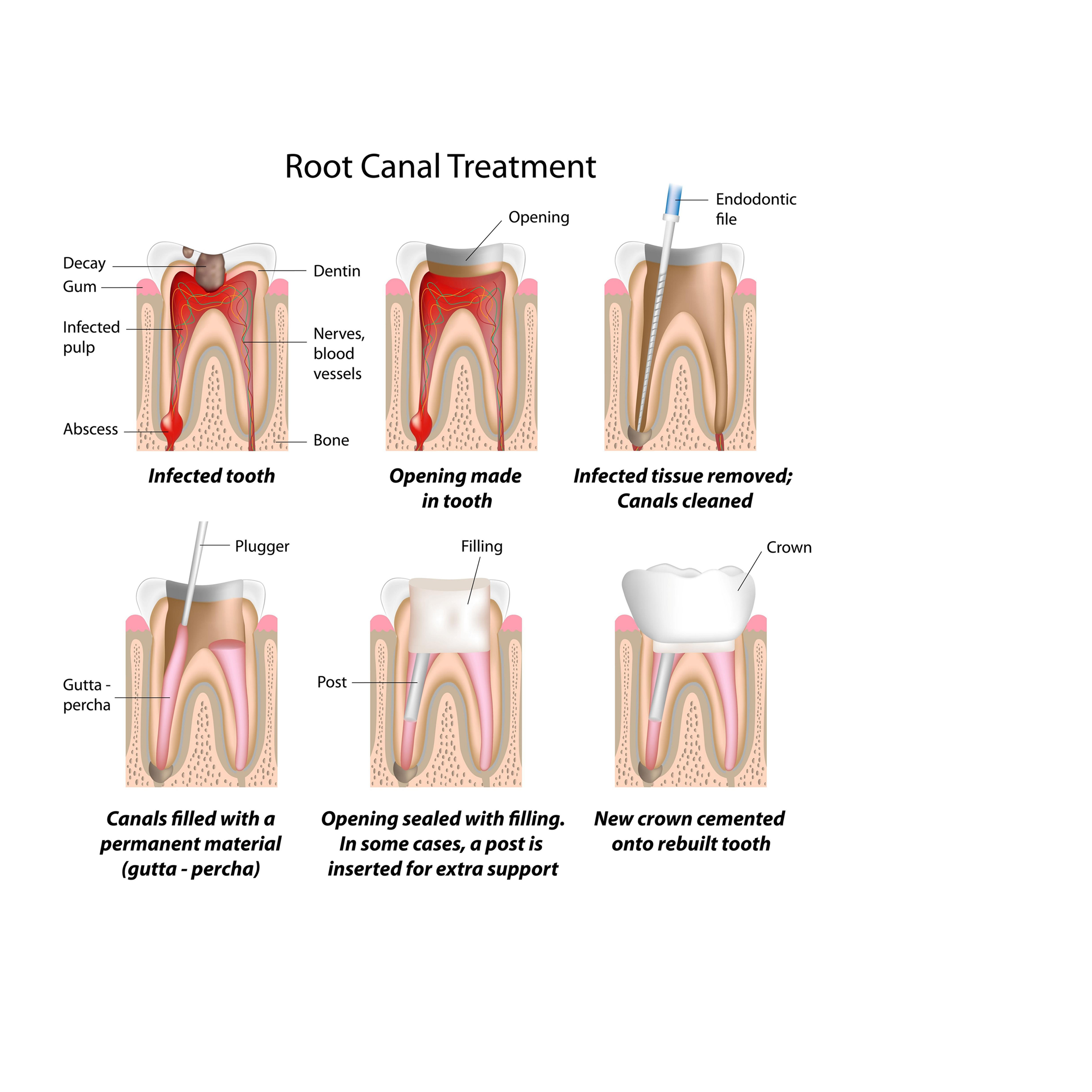 Root Canal Treatment in Secunderabad