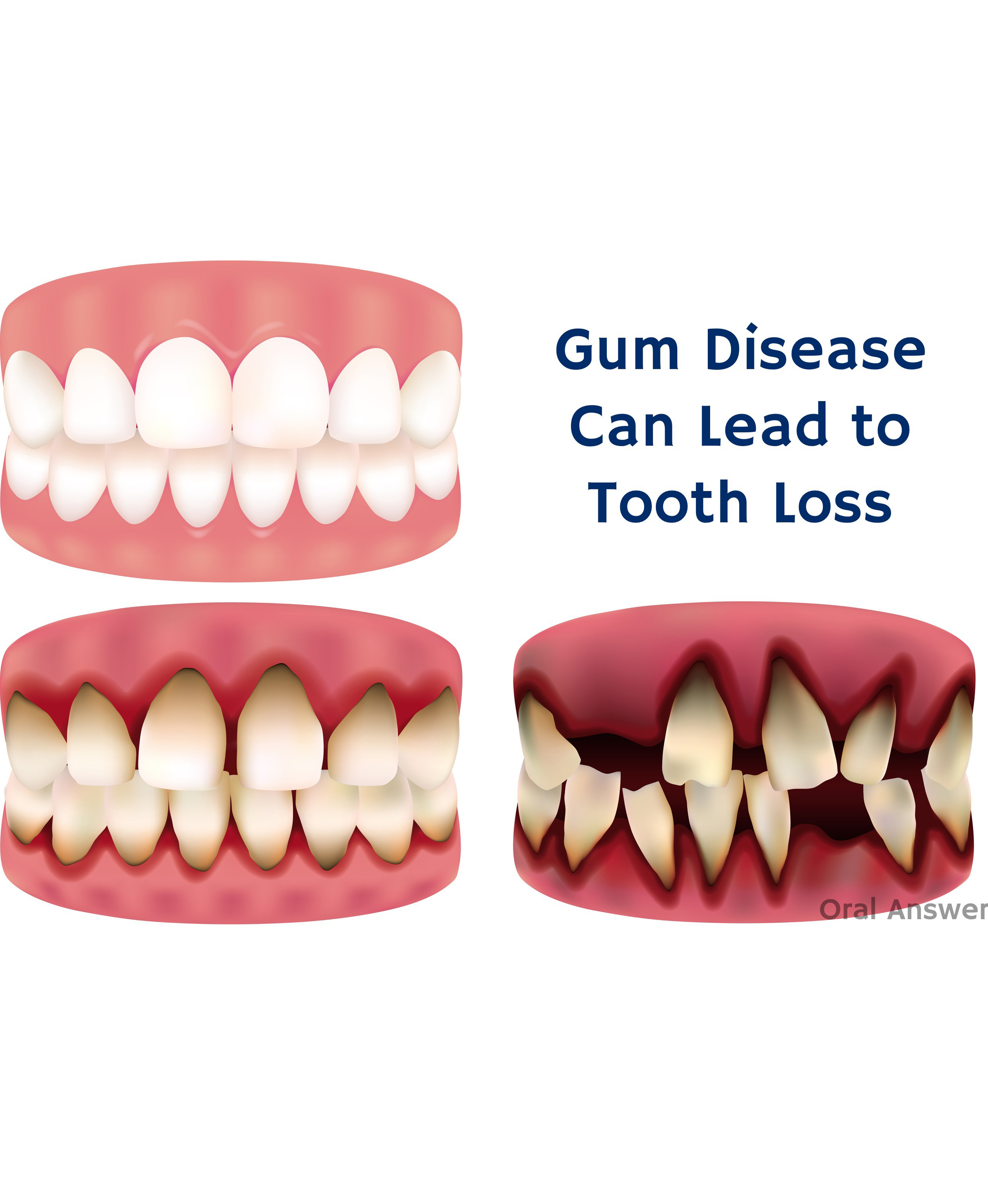 Gum Disease Treatment in Secunderabad