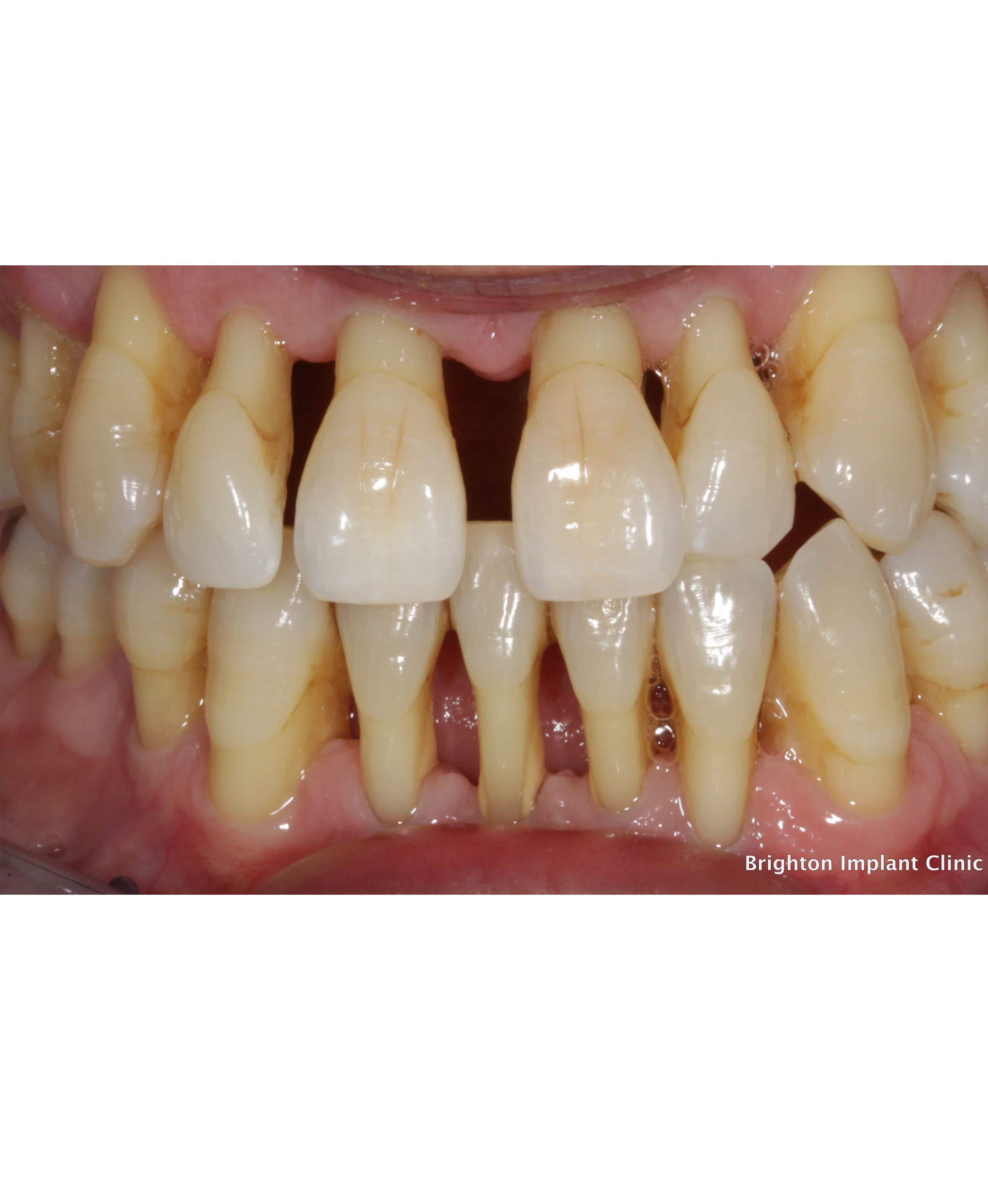 Gum Disease Treatment in Secunderabad